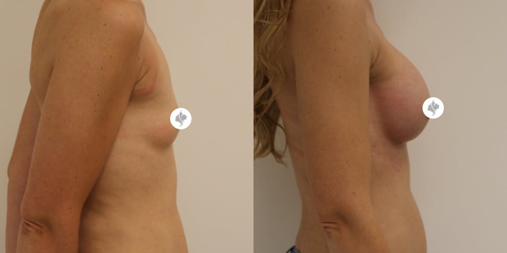 This is one of our beautiful breast augmentation patient #18