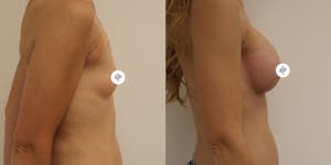 This is one of our beautiful breast augmentation patient 18