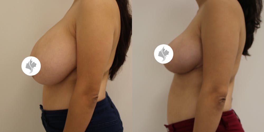 This is one of our beautiful breast reduction patient #52