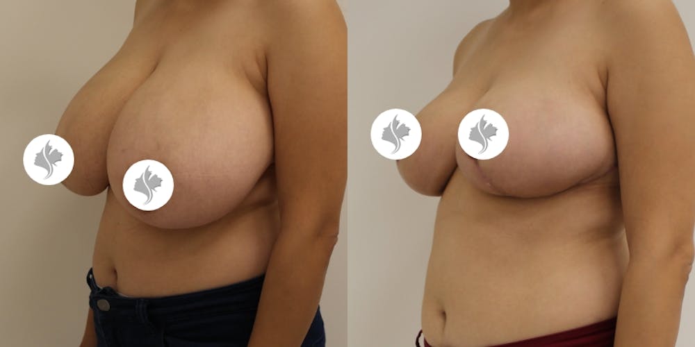 This is one of our beautiful breast reduction patient #52