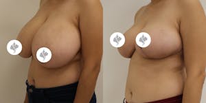 This is one of our beautiful breast reduction patient 52