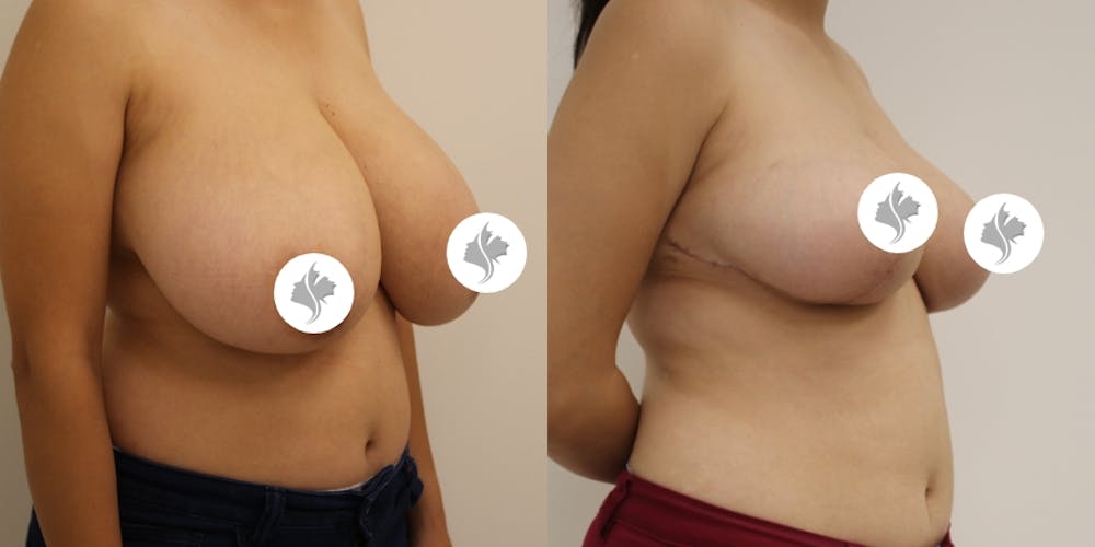 This is one of our beautiful breast reduction patient #52