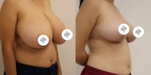 This is one of our beautiful breast reduction patient 52