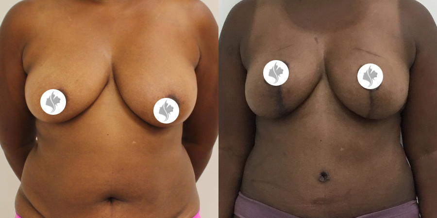 This is one of our beautiful breast reduction patient 53