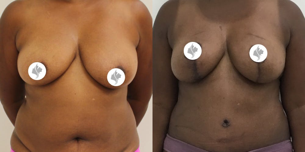 This is one of our beautiful breast reduction patient #53