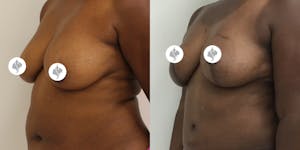 This is one of our beautiful breast reduction patient 53