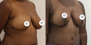 This is one of our beautiful breast reduction patient 53