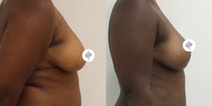This is one of our beautiful breast reduction patient 53