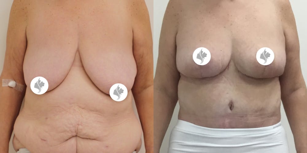 This is one of our beautiful breast reduction patient #54