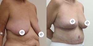 This is one of our beautiful breast reduction patient 54
