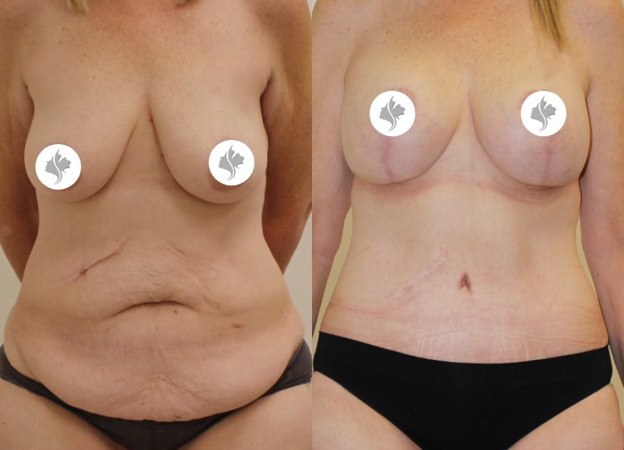 This is one of our beautiful tummy tuck patient 32