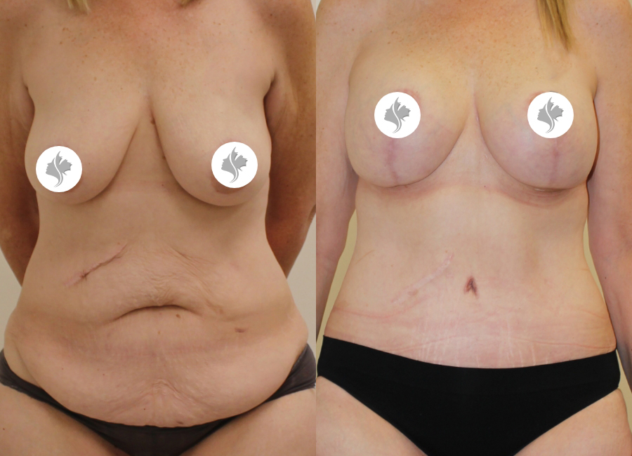 This is one of our beautiful tummy tuck patient 37