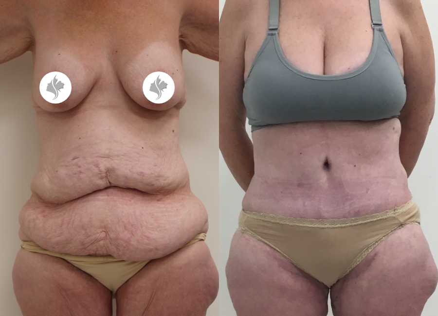 This is one of our beautiful tummy tuck patient 38