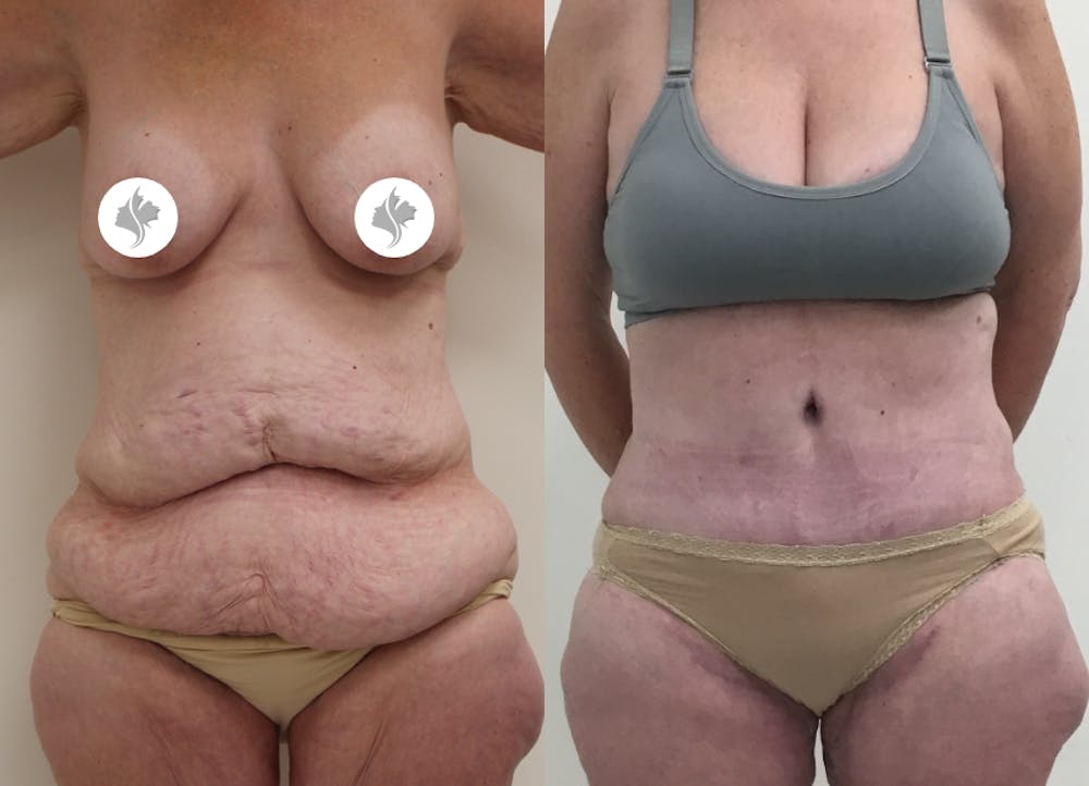 This is one of our beautiful post-bariatric body contouring patient #16