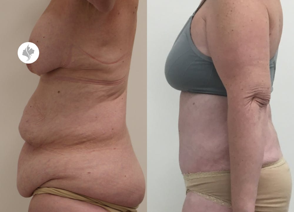 This is one of our beautiful post-bariatric body contouring patient #16