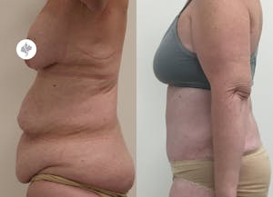 This is one of our beautiful post-bariatric body contouring patient 16