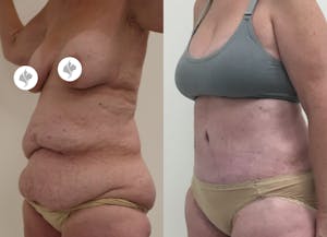 This is one of our beautiful post-bariatric body contouring patient 16