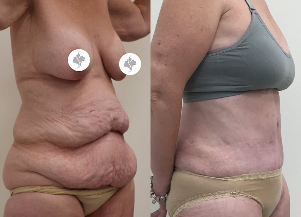 This is one of our beautiful post-bariatric body contouring patient #16