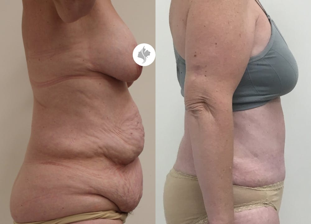 This is one of our beautiful post-bariatric body contouring patient #16