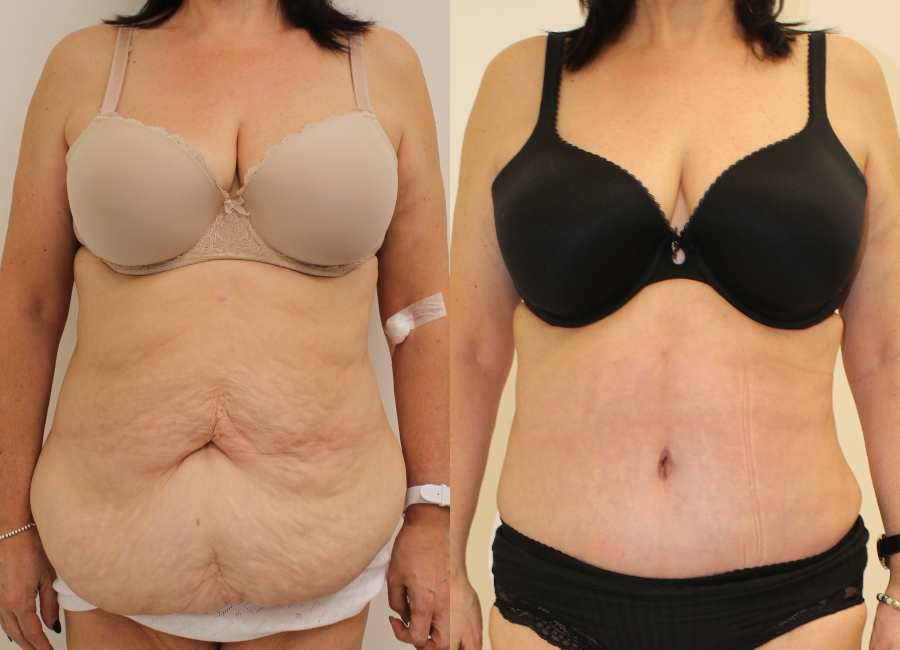 This is one of our beautiful post-bariatric body contouring patient 17