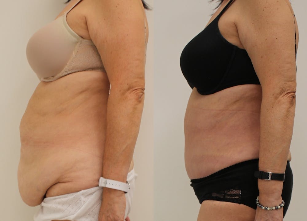 This is one of our beautiful post-bariatric body contouring patient #17