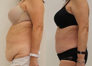 This is one of our beautiful post-bariatric body contouring patient 17