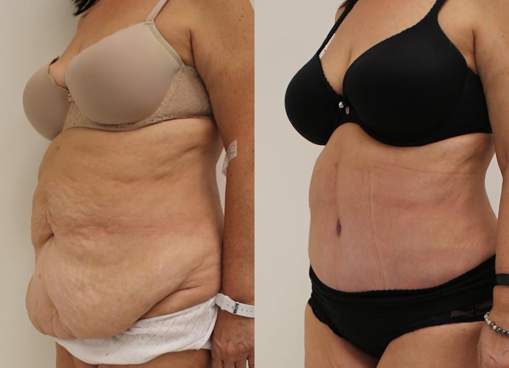 This is one of our beautiful post-bariatric body contouring patient #17