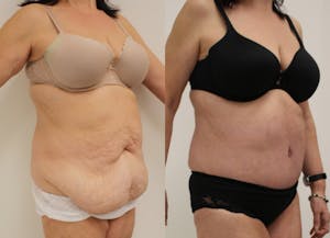 This is one of our beautiful post-bariatric body contouring patient 17