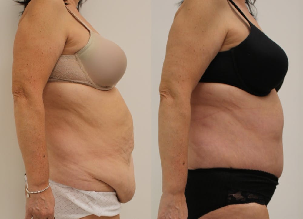 This is one of our beautiful tummy tuck patient #39