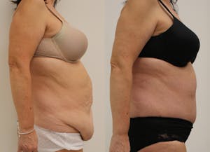 This is one of our beautiful post-bariatric body contouring patient 17