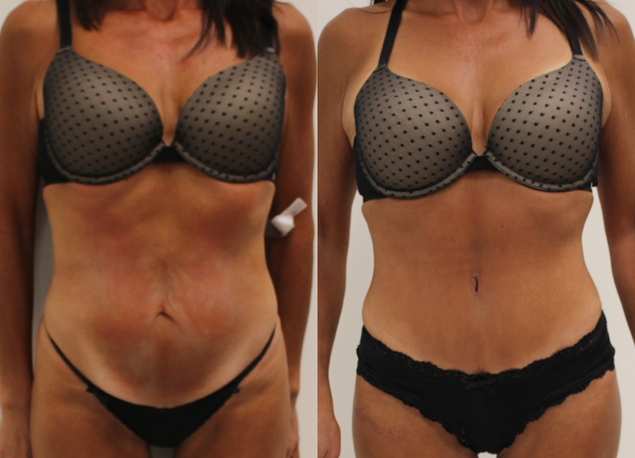 This is one of our beautiful tummy tuck patient 7