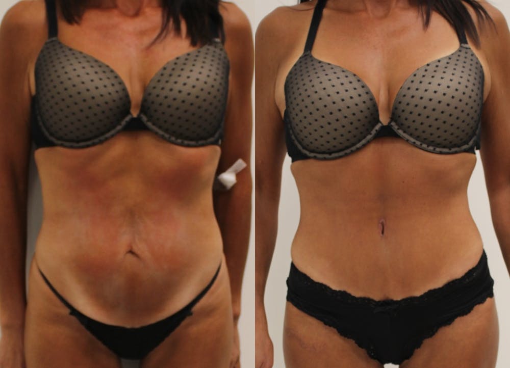 This is one of our beautiful tummy tuck patient #35