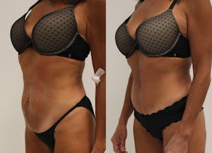 This is one of our beautiful tummy tuck patient 35