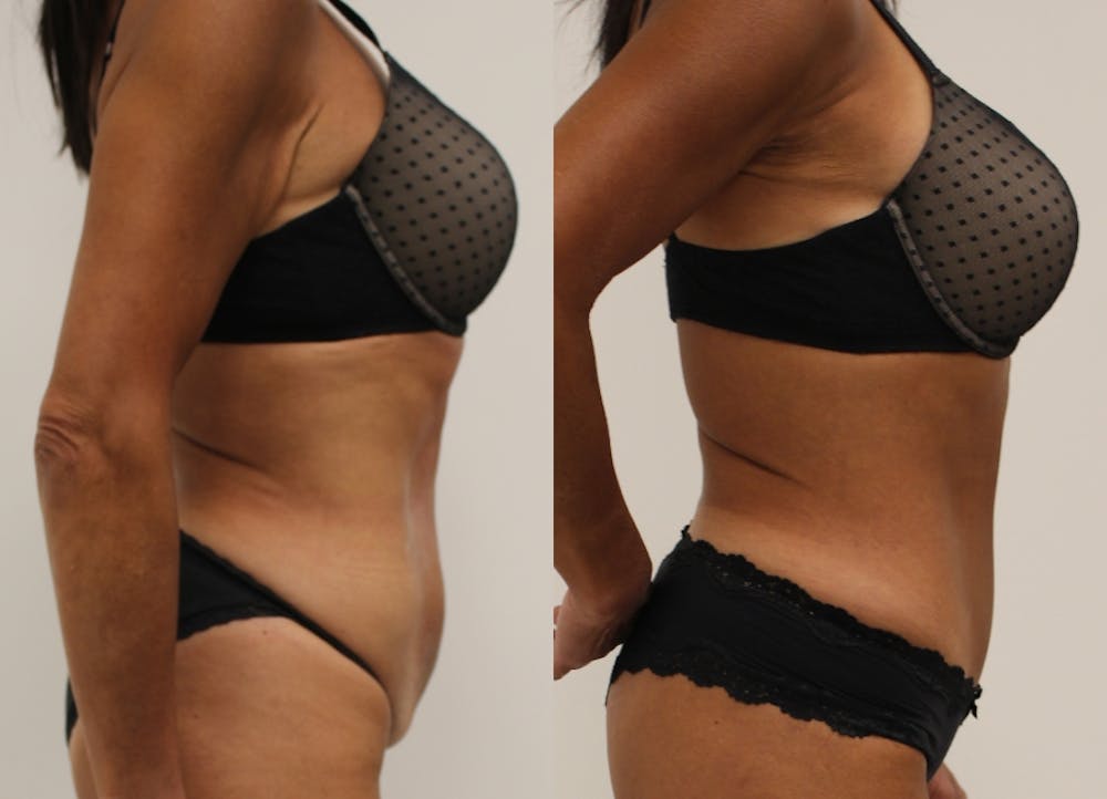 This is one of our beautiful tummy tuck patient #7