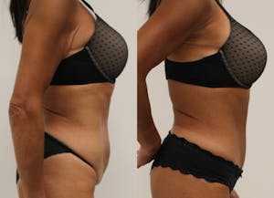 This is one of our beautiful tummy tuck patient 35