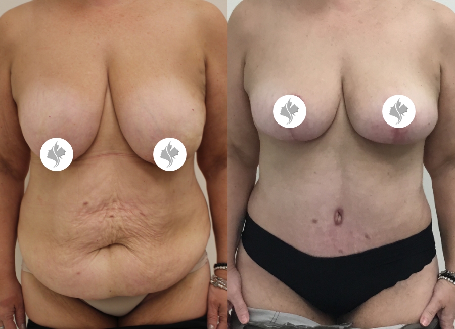 This is one of our beautiful post-bariatric body contouring patient 18