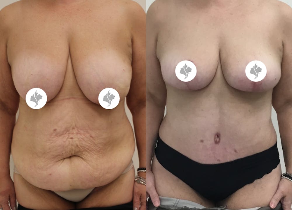 This is one of our beautiful post-bariatric body contouring patient #18