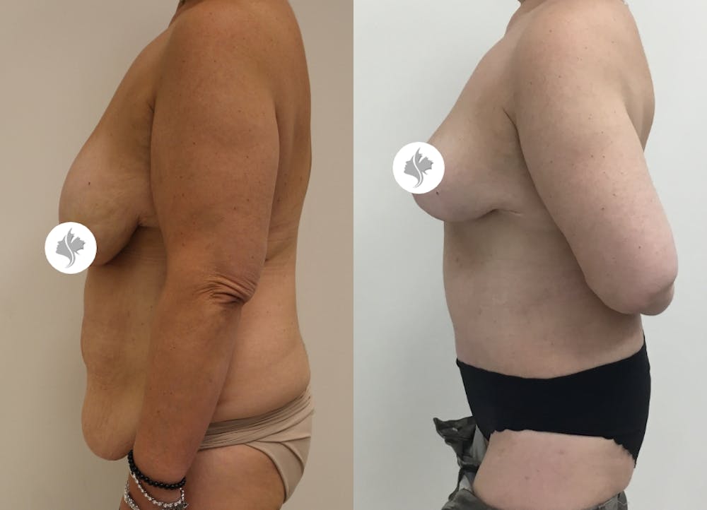 This is one of our beautiful post-bariatric body contouring patient #18