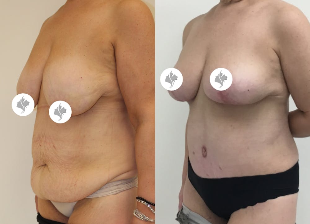 This is one of our beautiful tummy tuck patient #40