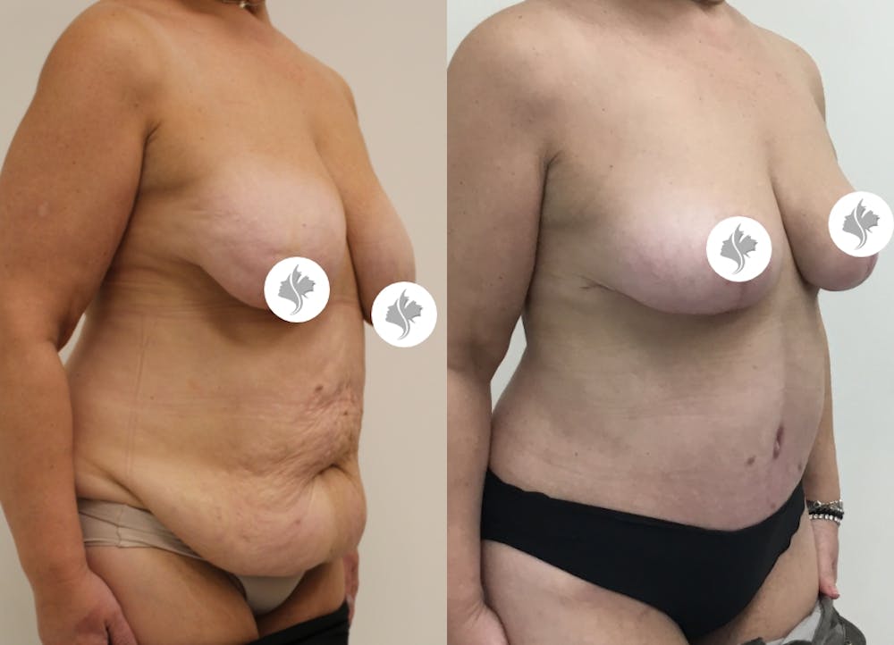 This is one of our beautiful post-bariatric body contouring patient #18
