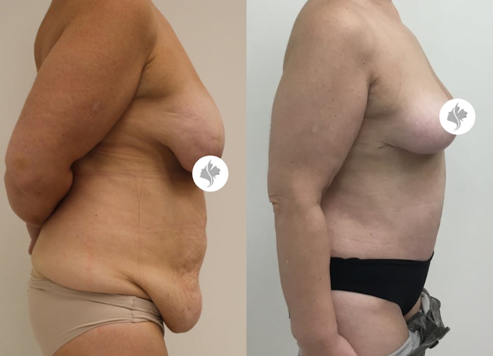 This is one of our beautiful post-bariatric body contouring patient #18