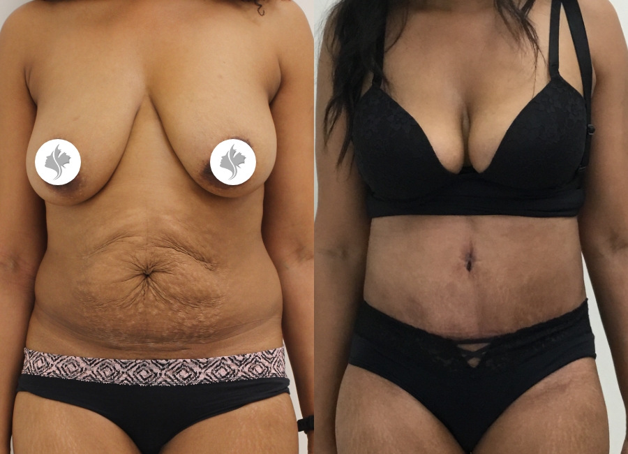 This is one of our beautiful tummy tuck patient 41