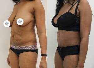 This is one of our beautiful tummy tuck patient 37