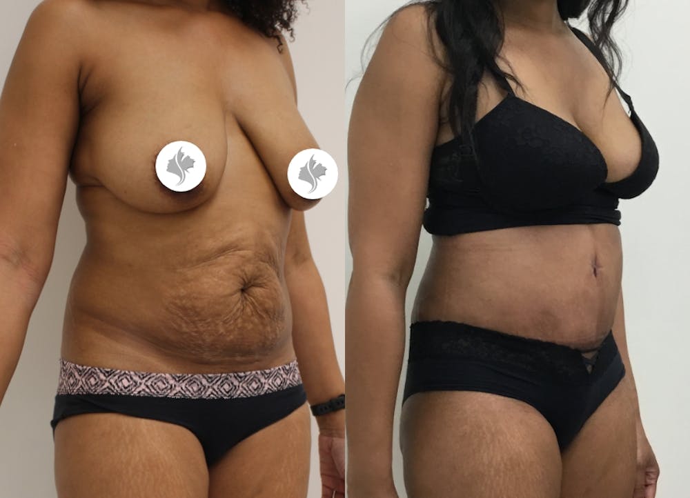 This is one of our beautiful tummy tuck patient #37