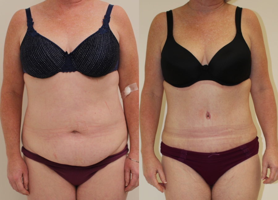This is one of our beautiful tummy tuck patient 38