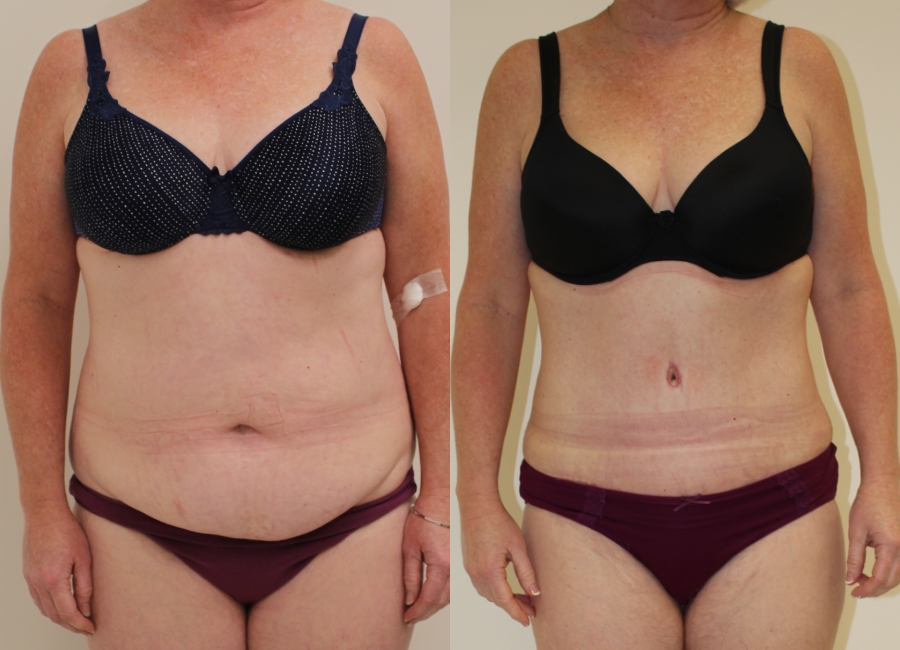 This is one of our beautiful tummy tuck patient 42