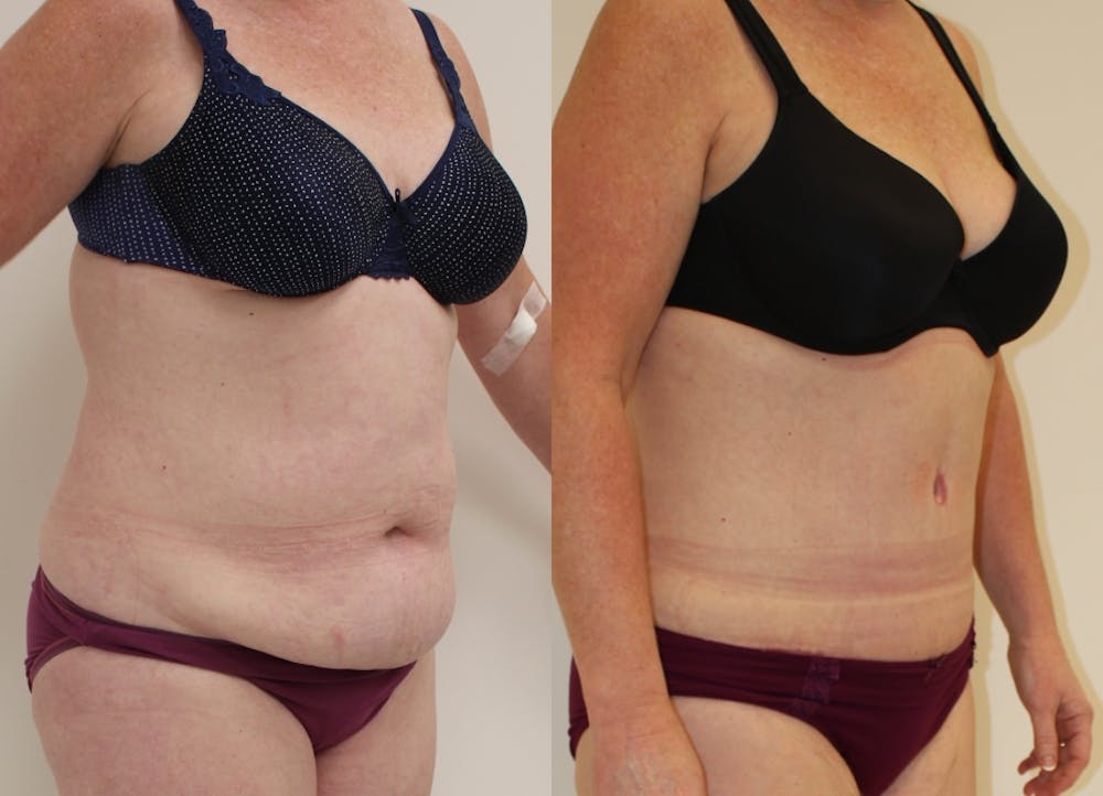 This is one of our beautiful tummy tuck patient #42