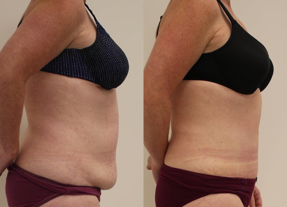 This is one of our beautiful tummy tuck patient #42