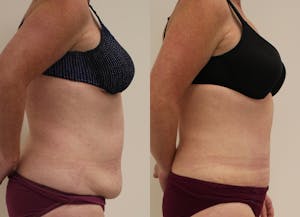 This is one of our beautiful tummy tuck patient 38
