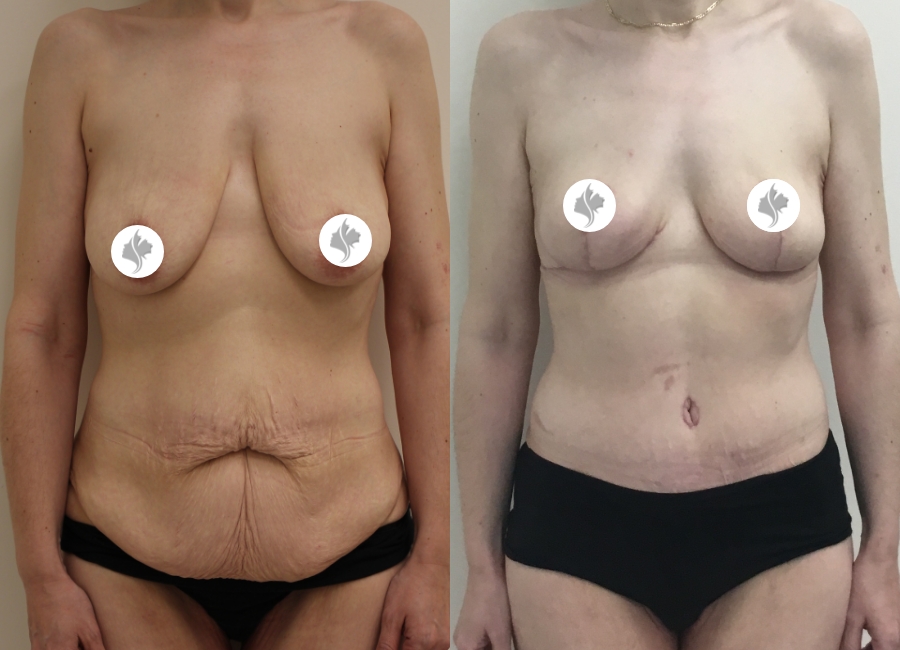 This is one of our beautiful tummy tuck patient 43